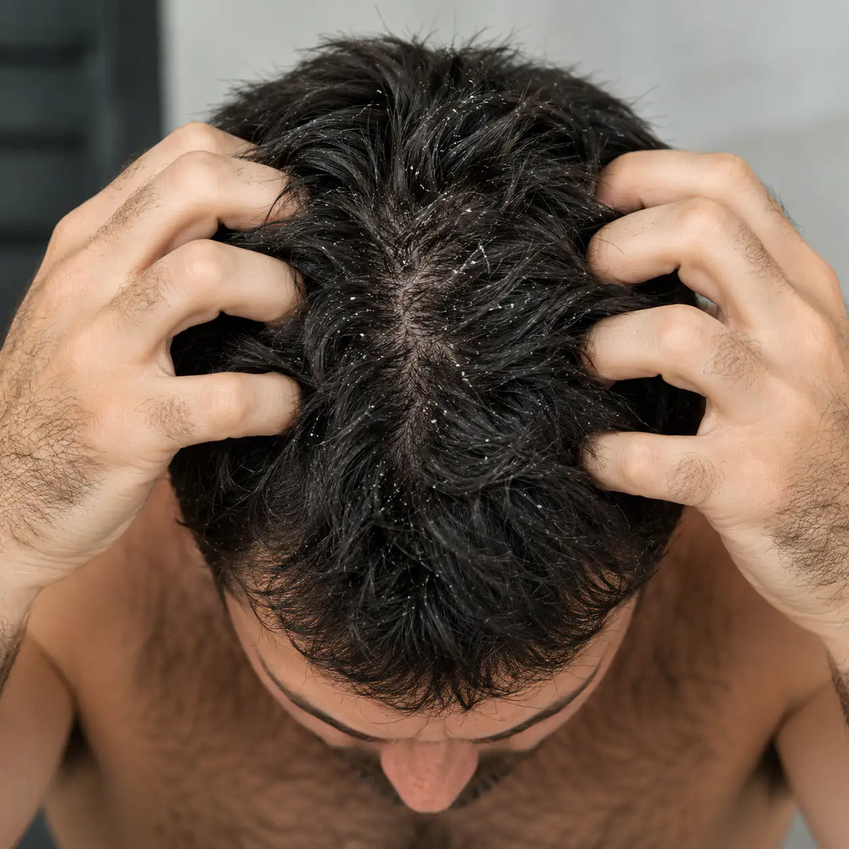 Un homme vue du dessus se gratant les cheveux avec des poux