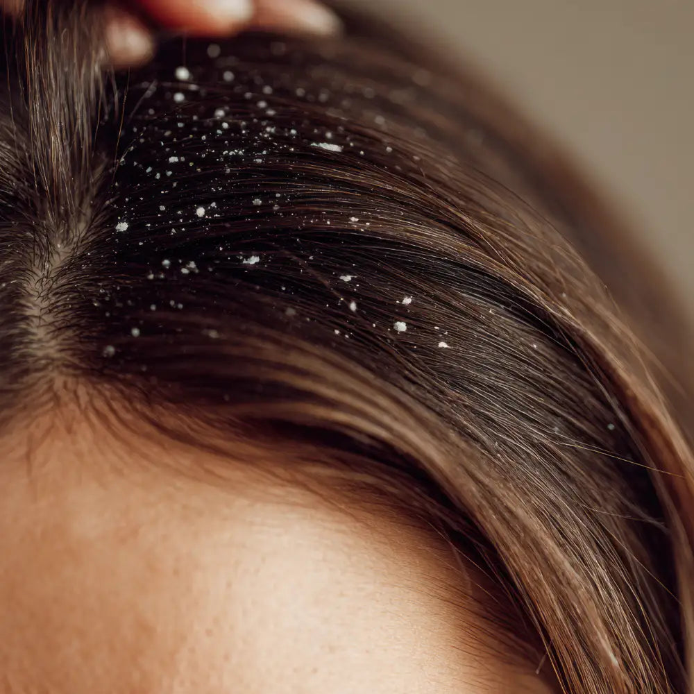 Zoom sur le sommet du crâne d'une personne avec des points blancs dans les cheveux